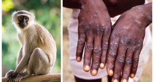 Rare case of monkeypox confirmed in England